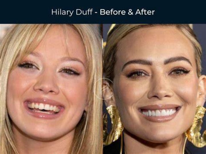 Celebs With The Worst Teeth