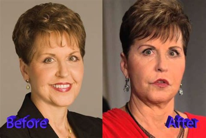 Joyce Meyer Plastic Surgery With Before And After Photos