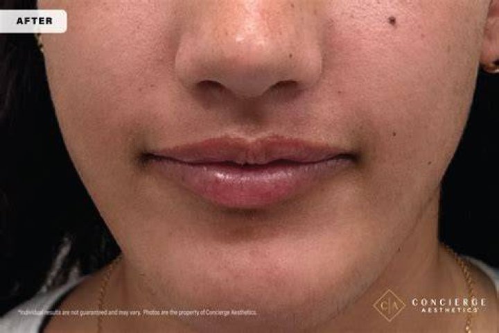 Treating &lsquo;MShaped&rsquo; Lips Aesthetics